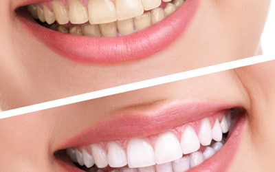 Teeth Whitening