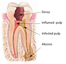 endodontic tooth