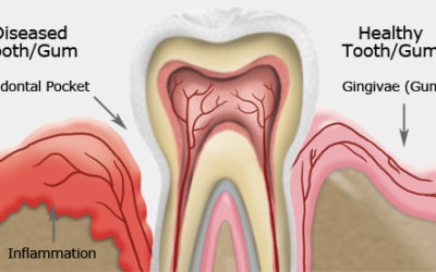 What Is Gum Disease?