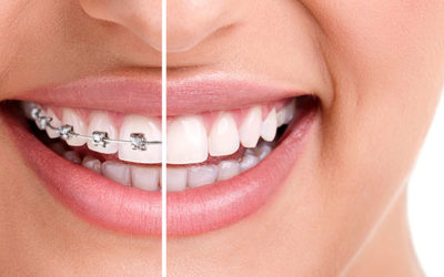 Braces And What You Need To Know