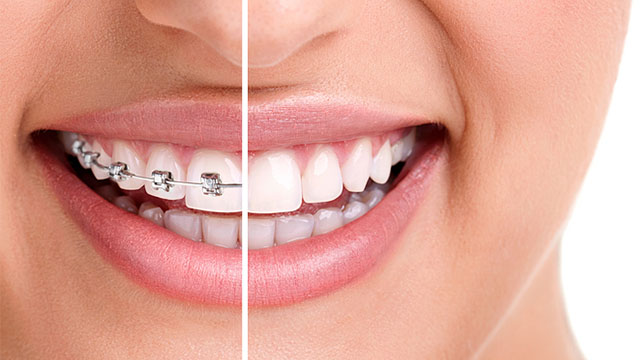 Braces And What You Need To Know