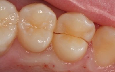 What Is A Cracked Tooth?