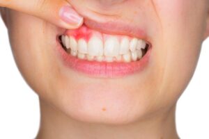 Periodontal Disease: The #1 Cause of Tooth Loss in Adults