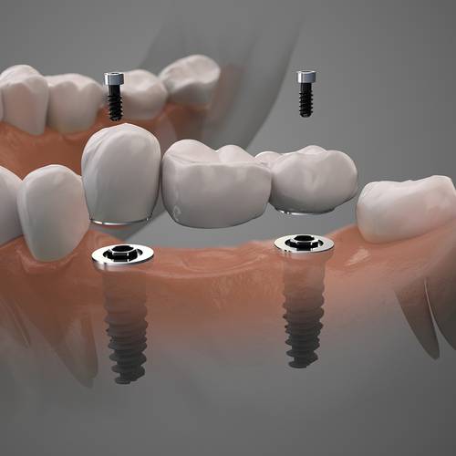 Dental Services Premier Dental Omaha Ne Cosmetic Dentistry Dental Implants Image