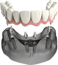Dental implant prosthetic showing artificial teeth structure above jawbone model with implant posts.