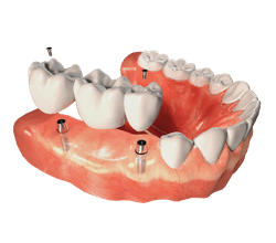 Dental implant model showing prosthetic teeth attachment on gum structure with implant posts.