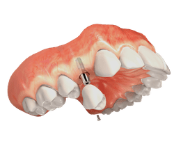 Dental implant model showing tooth replacement procedure with implant post in jawbone structure.